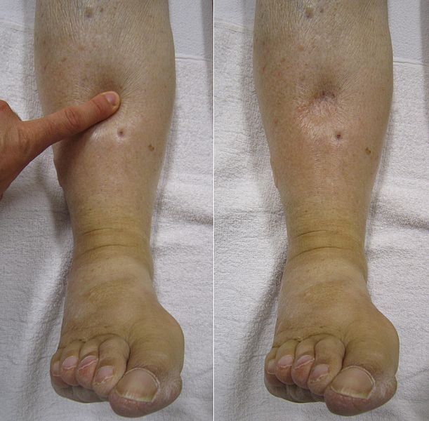 File:PedalEdema.jpg
