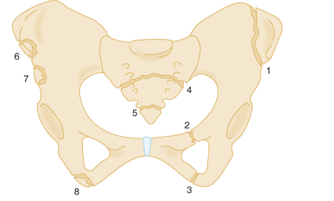 File:PelvicAvulsion.png