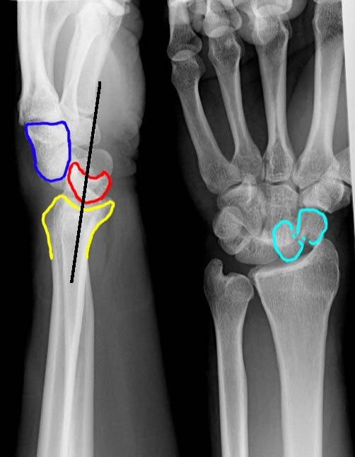 Perilunate Dislocation.jpg