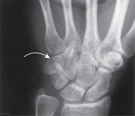 Pisiform Fracture.jpg