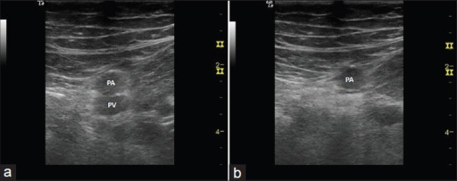 Popliteal artery and vein.png