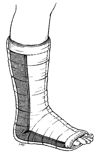 Posterior Ankle Splint.gif