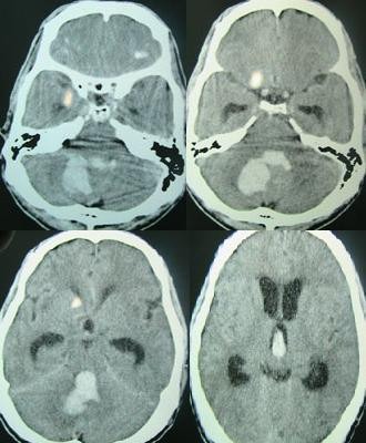 File:Posterior fossa hemorrhage.jpg
