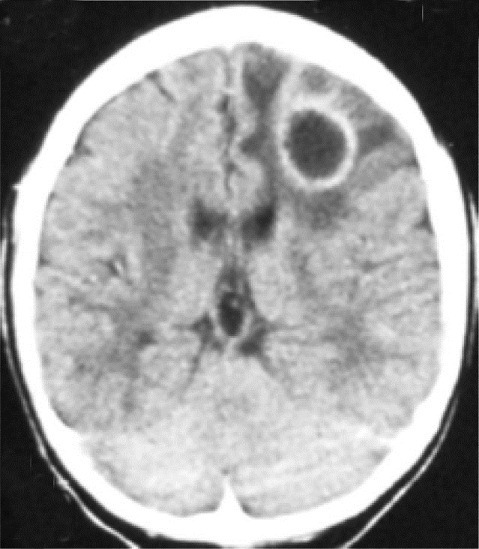 File:Ring enhancing lesion on CT.png