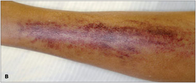File:Scruvy - Easy bruising.png