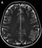 File:T2 Brain.png