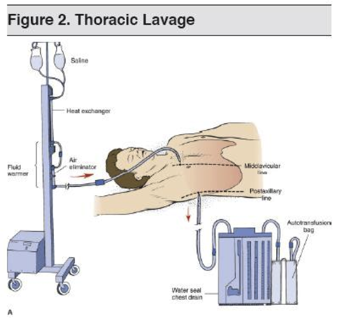 Thoraciclavage.png