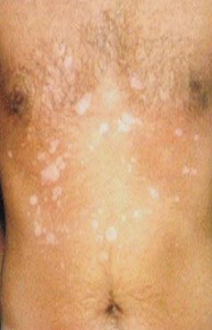Tinea versicolor.JPG