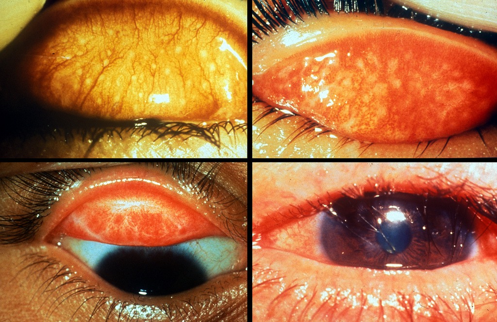 thumbnailTrachoma Stages by Flickr:CommunityEyeHealth
