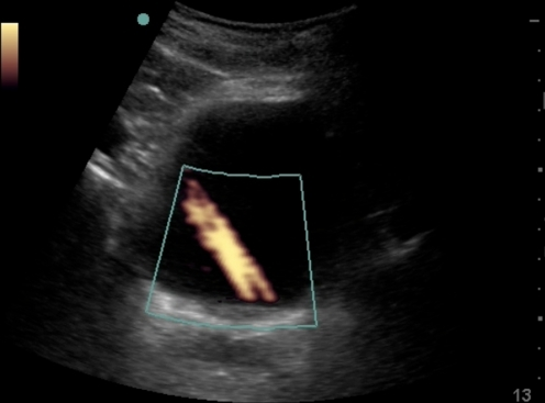 File:Ureteral jets.png