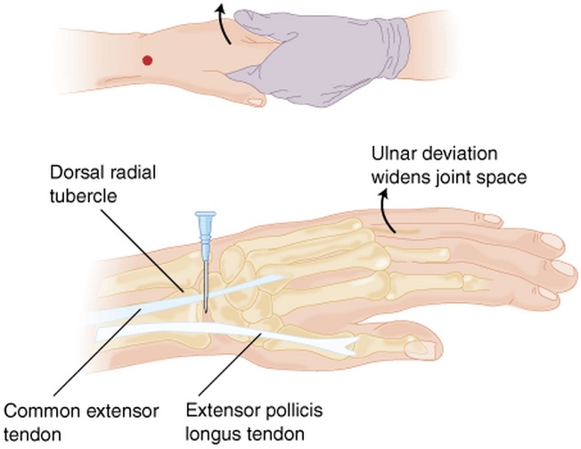 Wrist Arthrocentesis.jpg