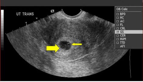 File:Yolk sac.jpg