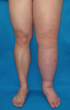 3lymphedema.png