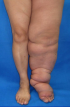 4lymphedema.png