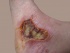 8-day-old-3rd-degree-burn.jpg