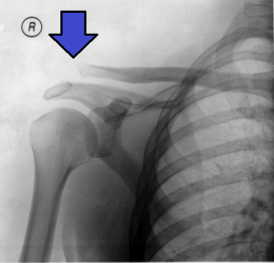 AC Separation XRAY (enhanced).png