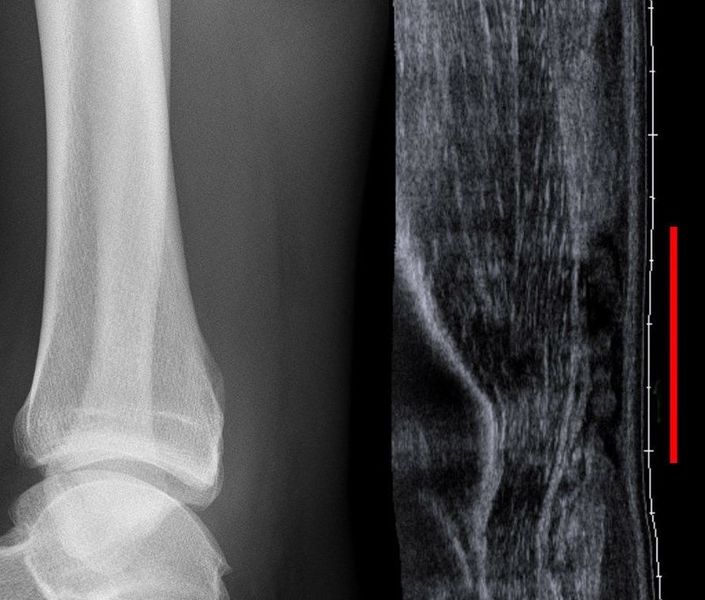File:Achilles tendon rupture.jpg