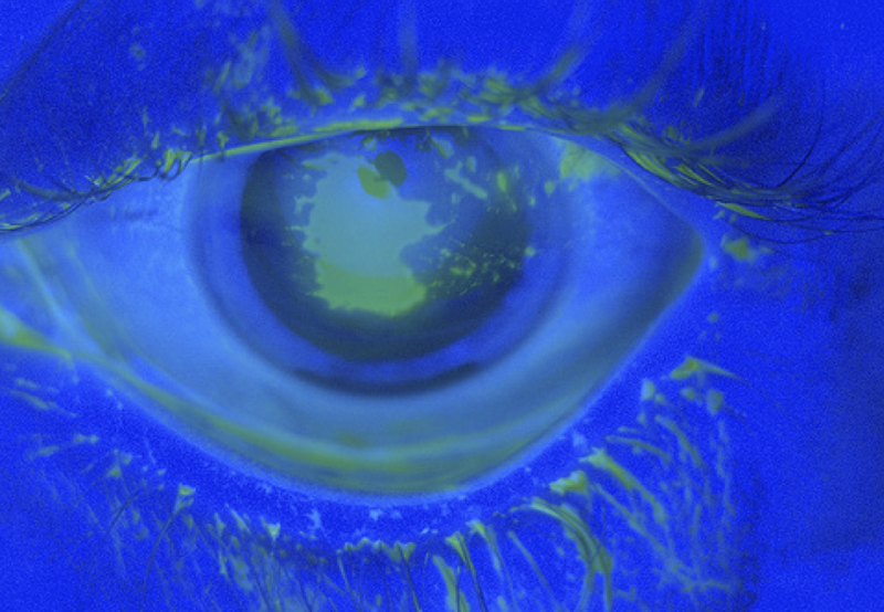 File:Airbag-corneal-abrasion1.png