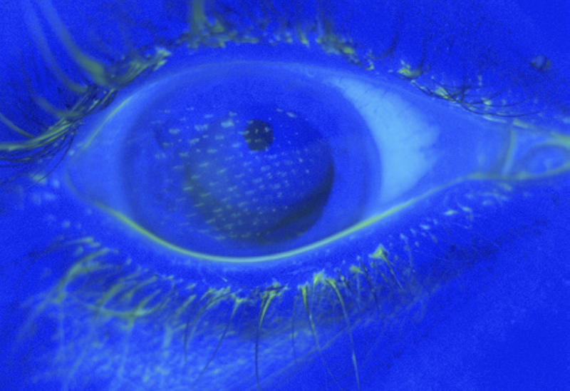 File:Airbag-corneal-abrasion2.png