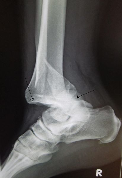 File:Ankledislocation.jpg