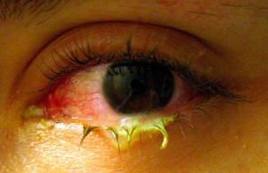Bacterial conjunctivitis.jpg