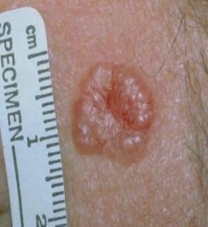 Basal cell carcinoma.JPG