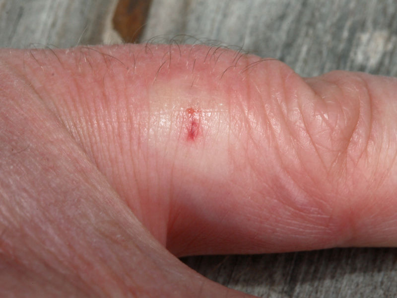 File:Bee sting 3.jpg