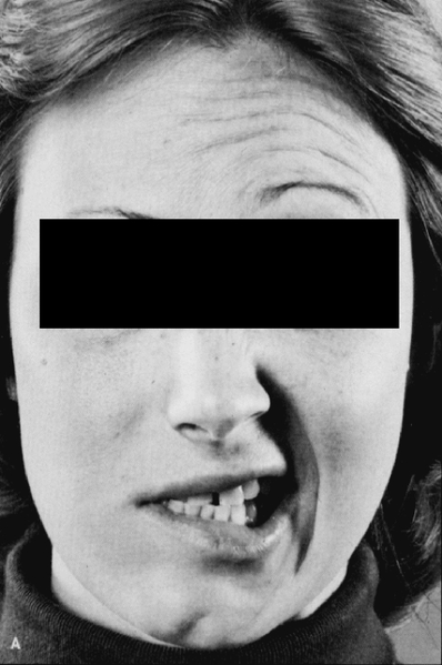 File:Bell's palsy.png