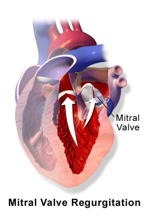 Blausen 0645 MitralValve Regurgitation.png