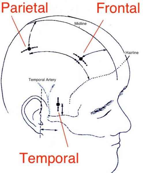 File:Burr hole.JPG
