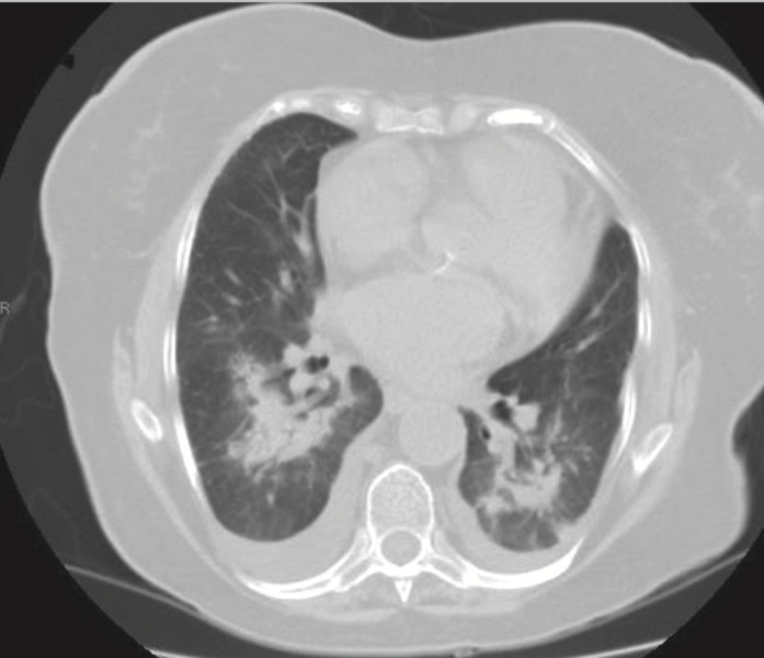 File:CT Amiodarone Lung Toxicity.png