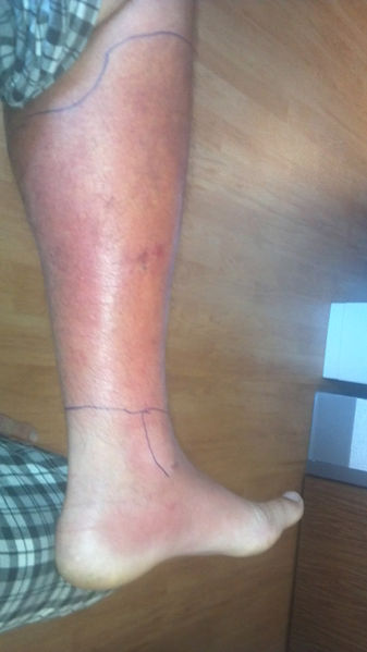 File:Cellulitis Of The Leg.jpg