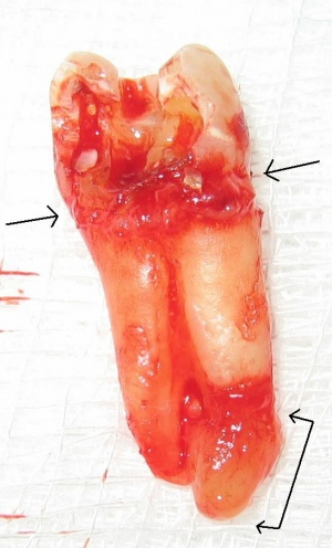 Chronic apical periodontitis (with arrows).jpg