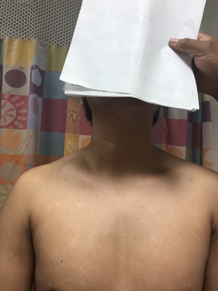 File:Clavicle fracture 2.jpg