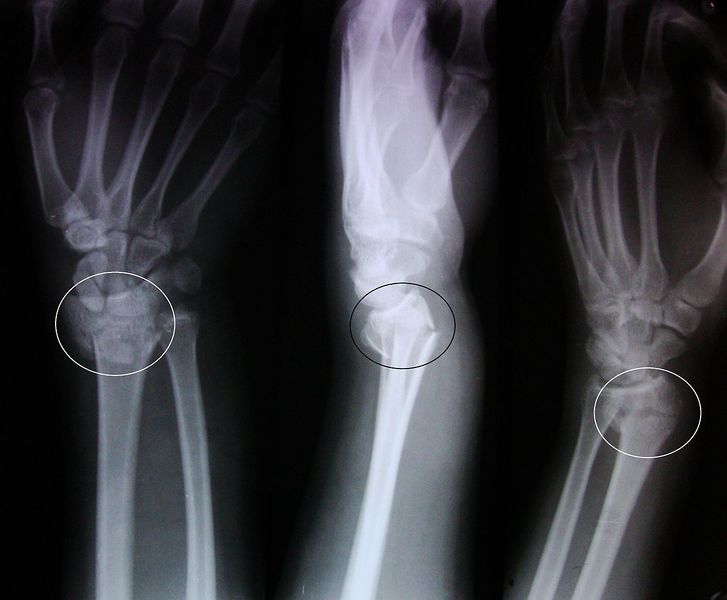 File:Colles fracture.JPG