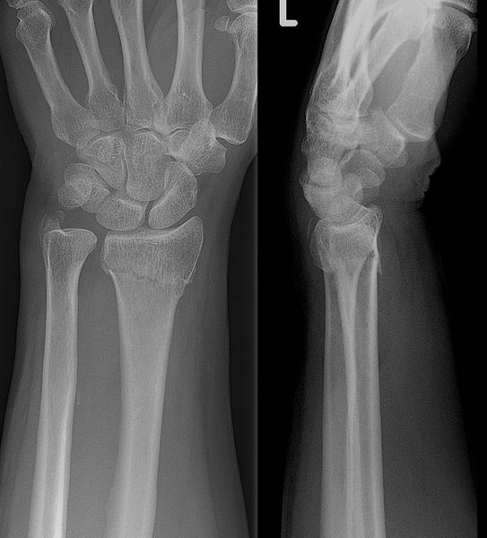 File:Collesfracture.jpg