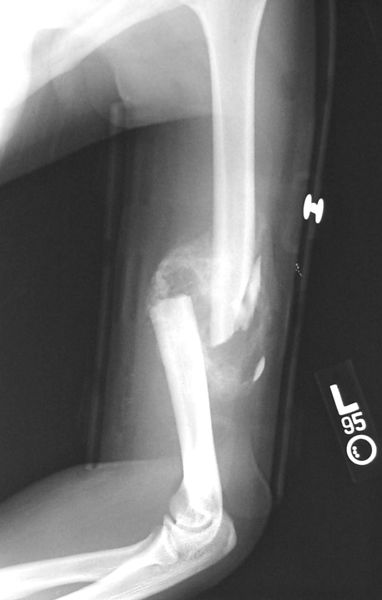 File:Communitive midshaft humeral fracture callus.jpg
