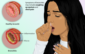Depiction of a person suffering from Bronchitis.png