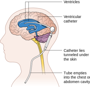 Diagram showing a brain shunt CRUK 052.svg.png