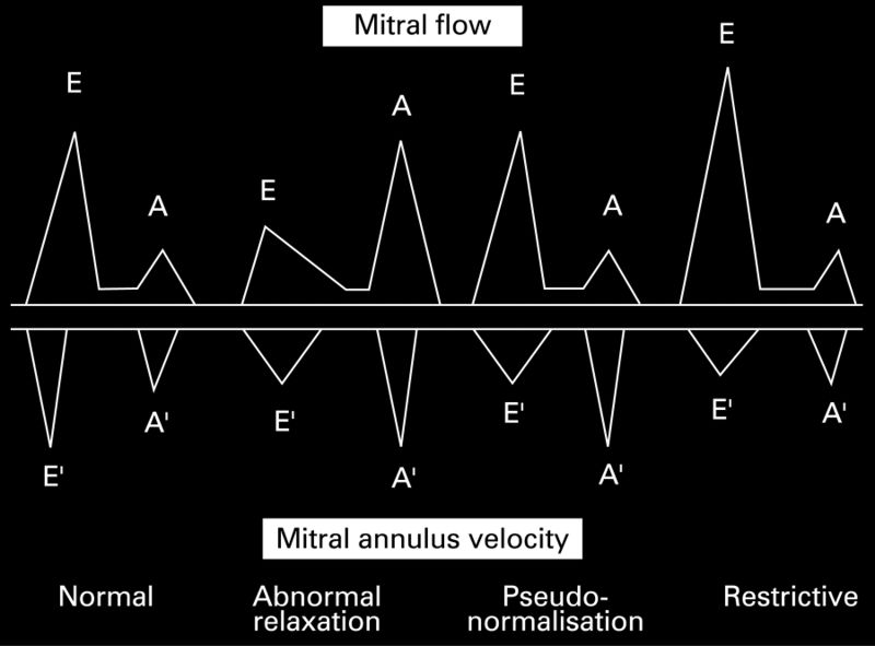File:Diastology chart.jpg