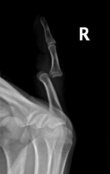 File:Dislocated Finger XRay.png