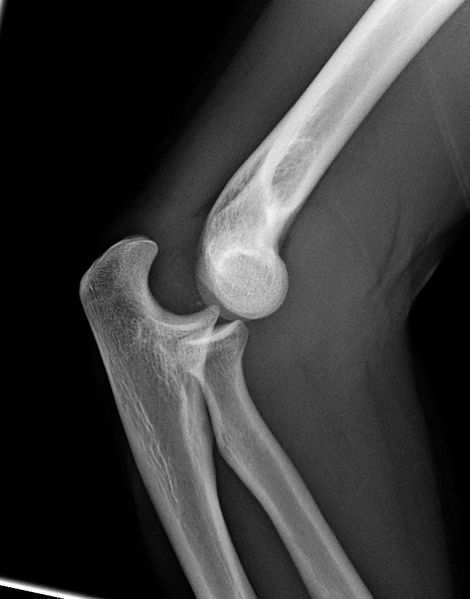 File:Elbow dislocation lateral.jpg