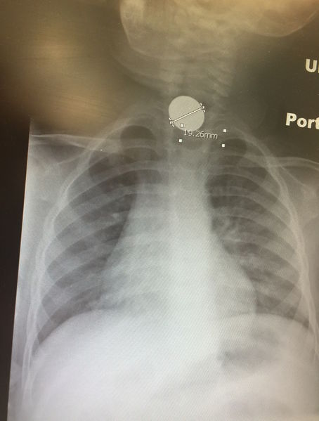 File:Esophageal fb.JPG