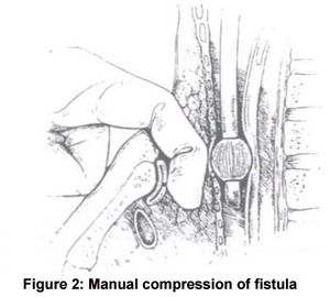 Finger tamponade.JPG