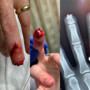 Fingertip avulsion.JPG
