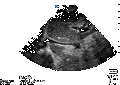Flat IVC 2.gif
