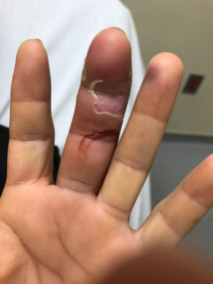 Flexor Tenosynovitis.JPG
