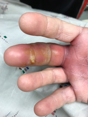 Flexor Tenosynovitis2.JPG