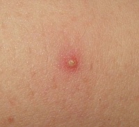 Folliculitis.jpg
