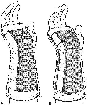 Forearm Volar Splint.gif